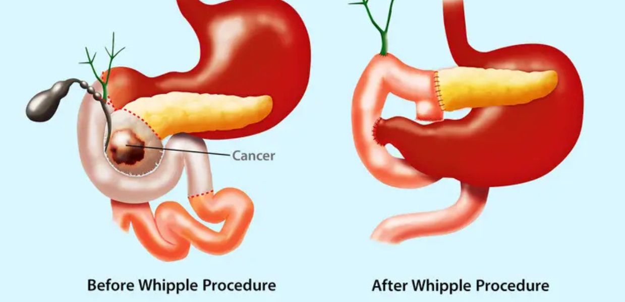 Whipple’s Surgery